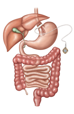 gastric-banding