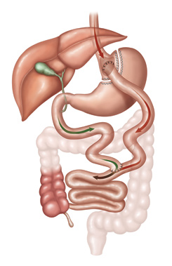 Roux-Y Bypass