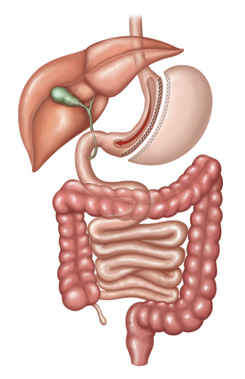 gastric sleeve