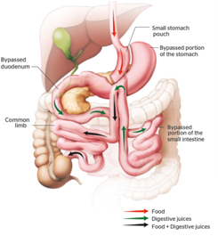 Mini Gastric Bypass Surgery